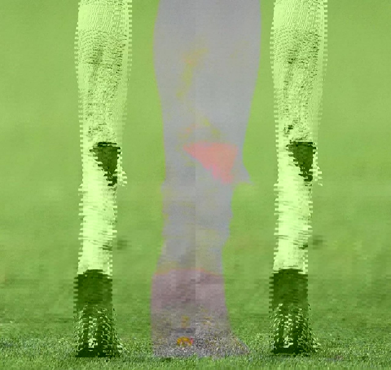 عکس دلخراش از پای زخمی امباپه