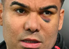 تصویر خبر کاسمیرو با چشم کبود هواداران را شوکه کرد: ستاره برزیلی یونایتد مصدوم، اما مصمم!